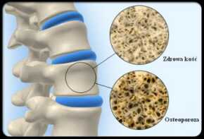 dieta przeciw osteoporozie