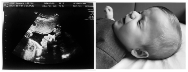 Ciąża in vitro w zdjęciach USG