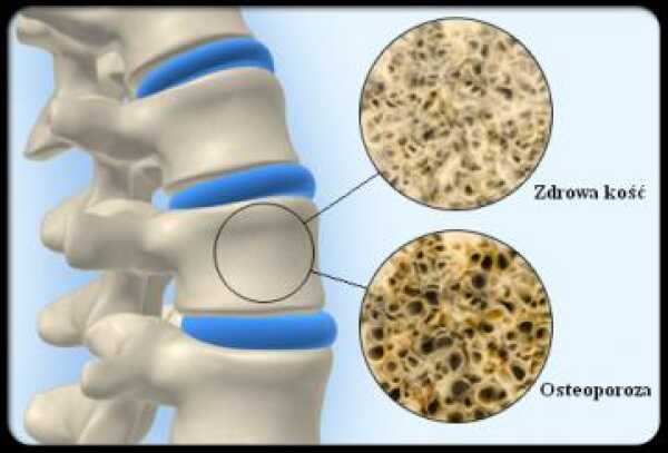 Dieta przeciw osteoporozie